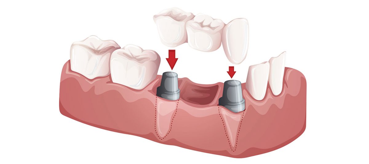 Bridge dentaire quels remboursements par les mutuelles santé ? Konpare